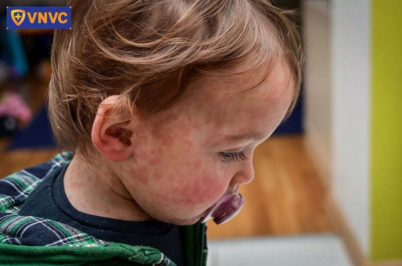 bé gái bị bệnh sởi