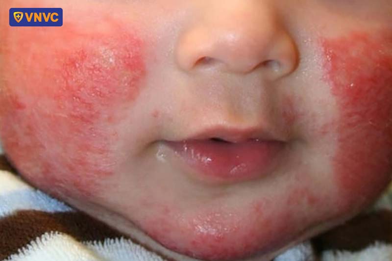 bé viêm da cơ địa tiêm vắc xin được không