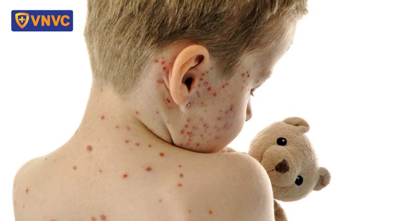 bệnh sởi ở trẻ em