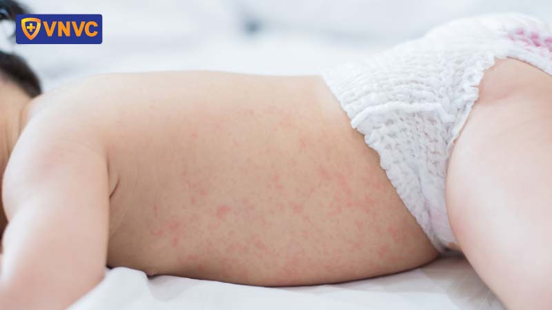 Nhấn vào ảnh để phóng to bệnh viêm da ở trẻ em
