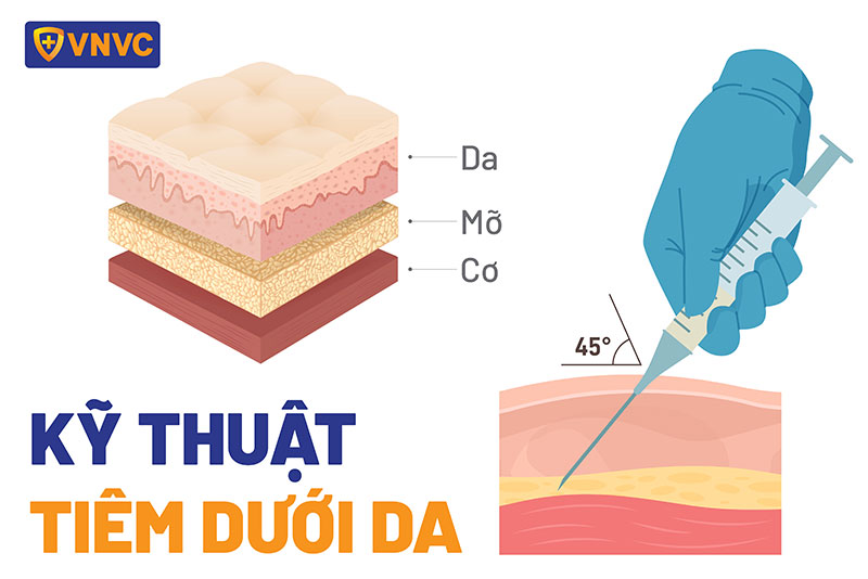 chọn đúng vị trí tiêm dưới da