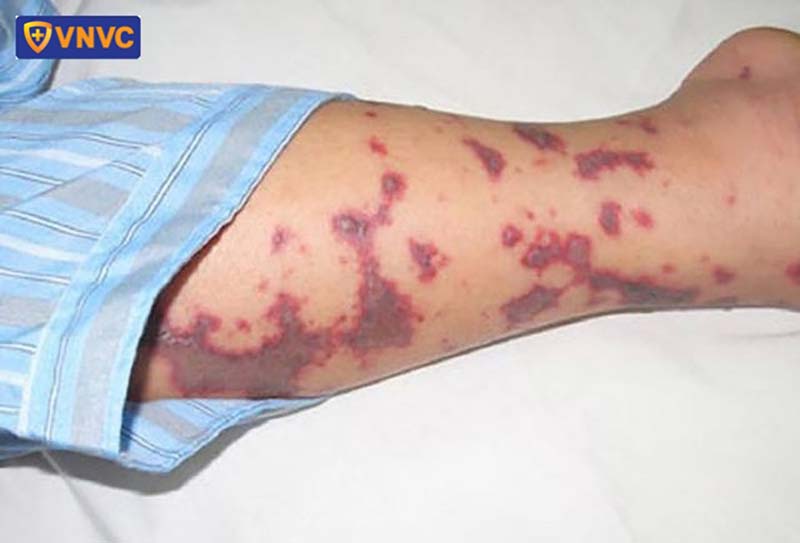 dấu hiệu viêm màng não mô cầu xuất hiện trên da