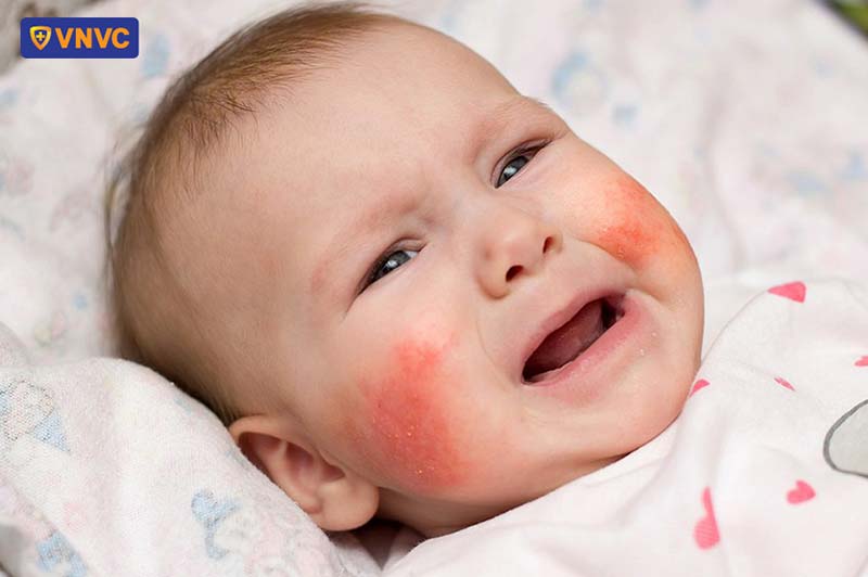 trẻ bị viêm da cơ địa tiêm vắc xin được không