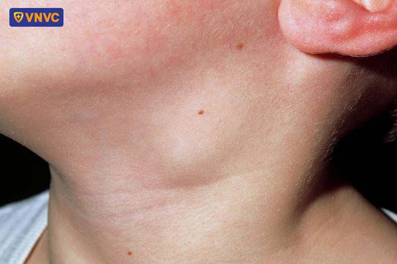 Nhấn vào ảnh để phóng to trẻ viêm hạch bạch huyết sau tiêm phòng