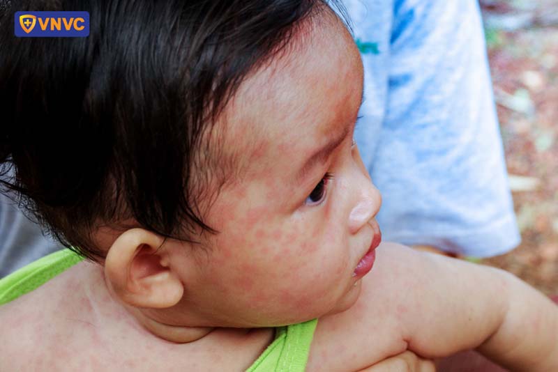 bệnh sởi ở trẻ 9 tháng tuổi