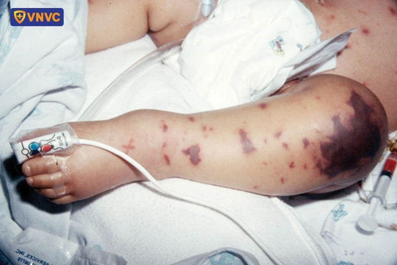 biến chứng do vi khuẩn Neisseria meningitidis