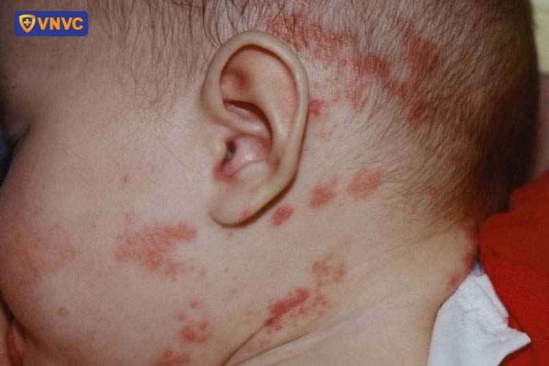 nhiễm trùng da ở trẻ