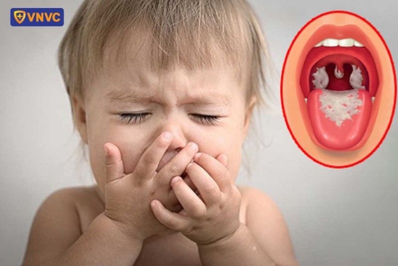 Bệnh bạch hầu là bệnh nhiễm trùng cấp tính