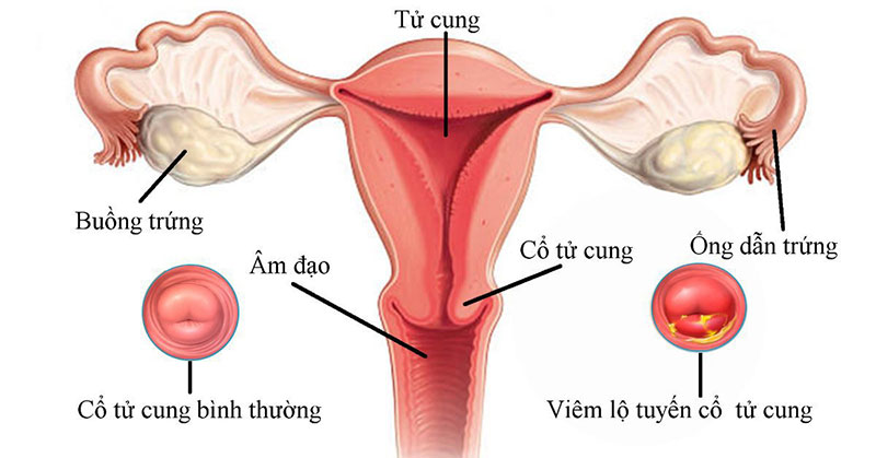 cổ tử cung