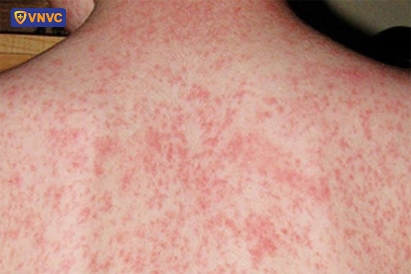 dấu hiệu bệnh sởi ở người lớn