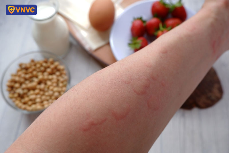 mẩn đỏ là biểu hiện của sốc phản vệ