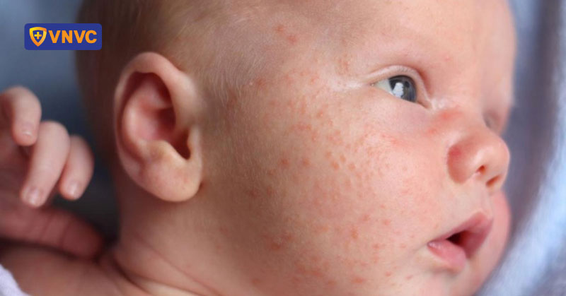 nguyên nhân bùng phát dịch sởi