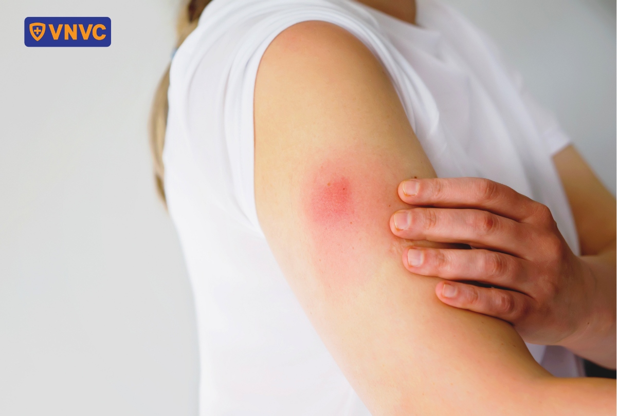 phản ứng phụ sau khi tiêm não mô cầu