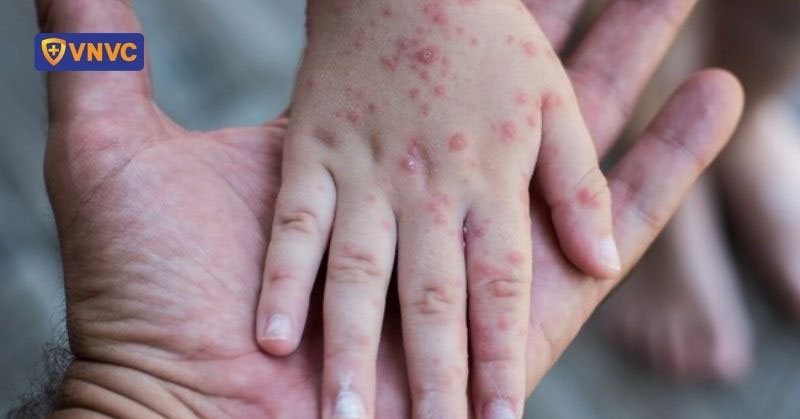 thói quen tăng nguy cơ mắc sởi