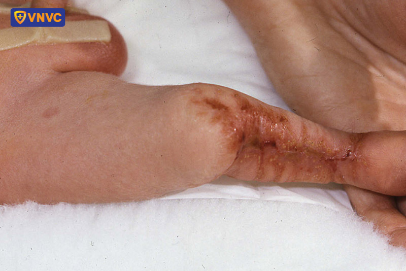 trẻ bị thủy đậu bẩm sinh