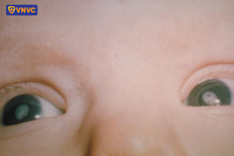 trẻ mắc hội chứng rubella bẩm sinh