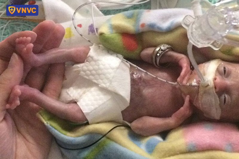 trẻ sinh non do mẹ mắc cúm trong thai kỳ