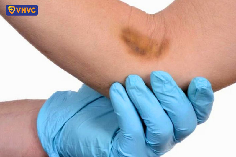 vết tiêm bầm tím
