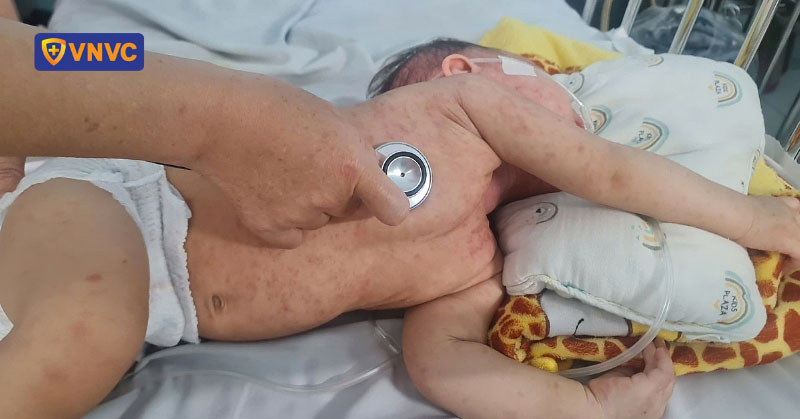 bé bị bệnh sởi