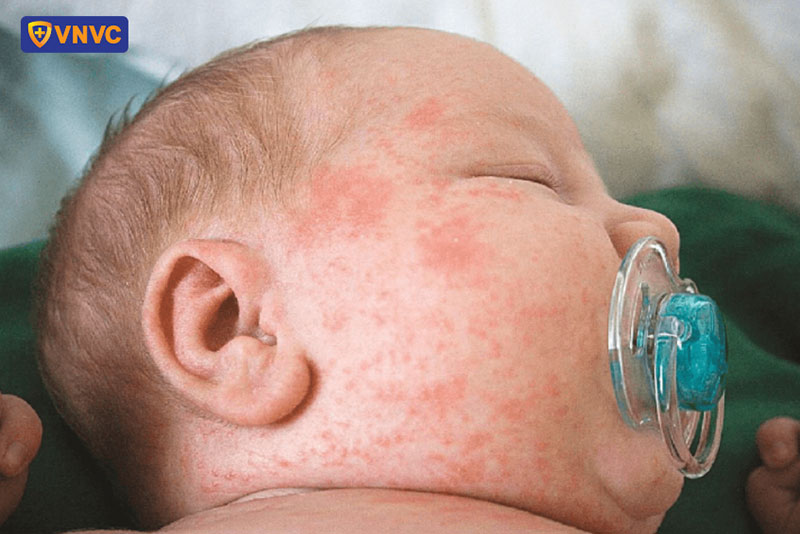 bé bị mắc bệnh sởi