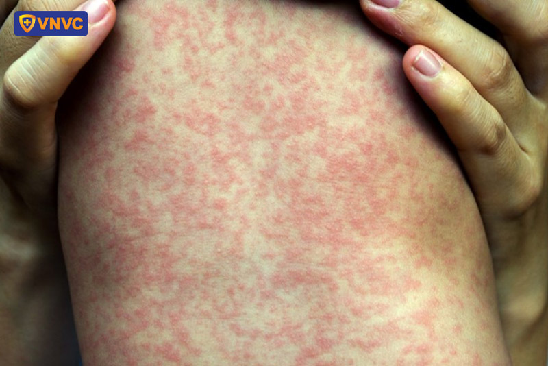bé bị sởi