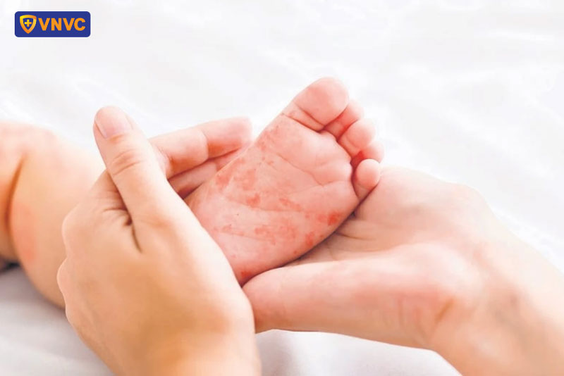 chăm sóc trẻ bị lên sởi