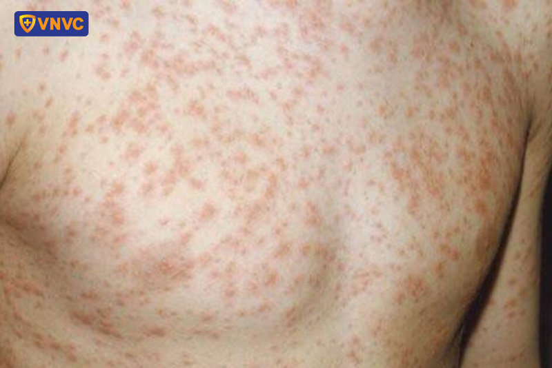 dấu hiệu bệnh sởi ở trẻ