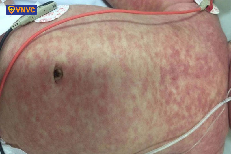 dấu hiệu của bệnh sởi