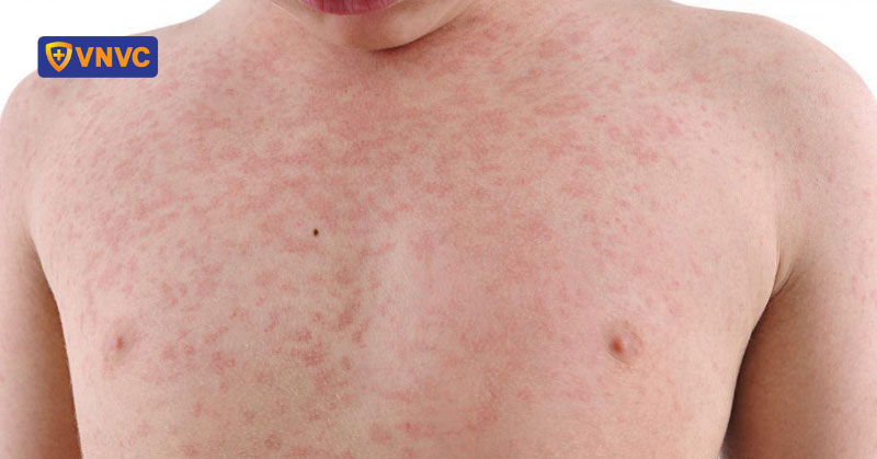 liên tiếp ghi nhận ca sởi