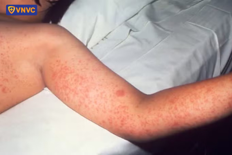 trẻ bị lên sởi