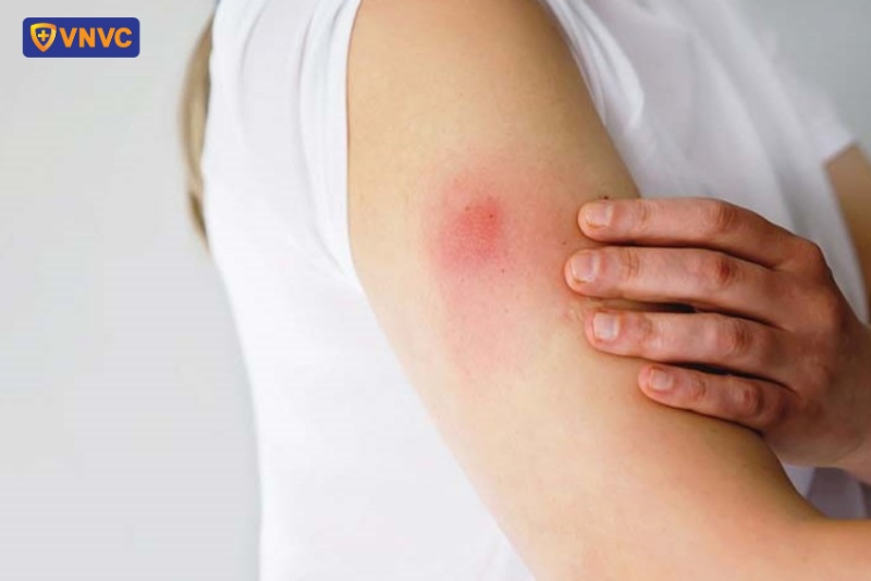 Các phản ứng sau tiêm vắc xin sốt xuất huyết Qdenga