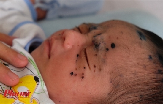 những bệnh thường gặp trong mùa hè