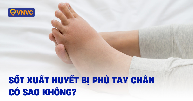 sốt xuất huyết bị phù tay chân có sao không