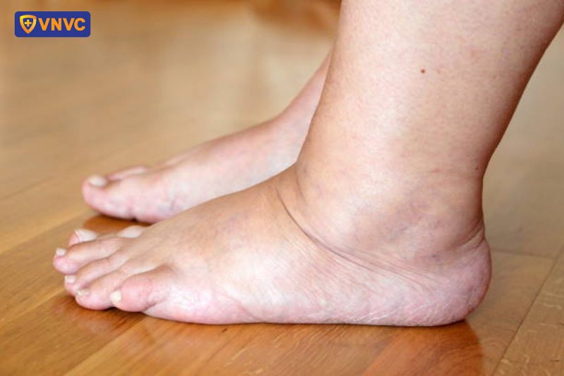 sốt xuất huyết bị phù tay chân