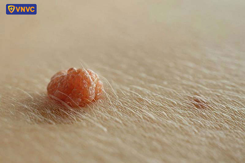 sùi mào gà ở nữ