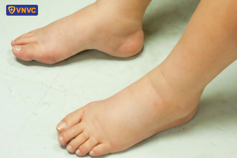 sưng nề tay chân do sốt xuất huyết