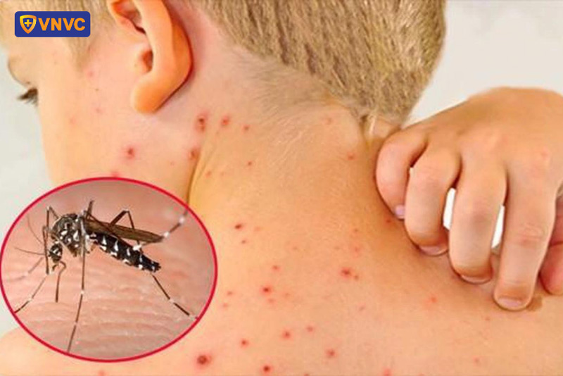 trẻ mắc sốt xuất huyết