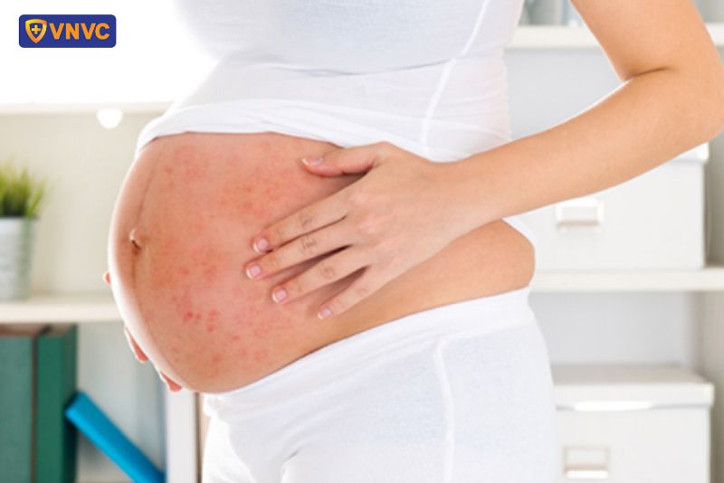 bà bầu bị zona thần kinh bôi thuốc gì