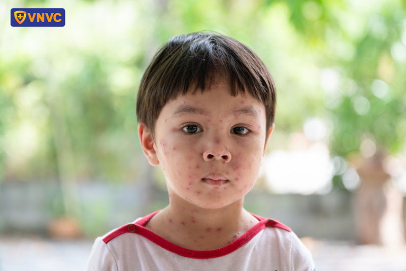 bé trai bị thủy đậu trên mặt