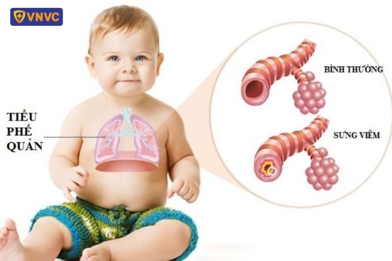 Bệnh viêm tiểu phế quản ở trẻ