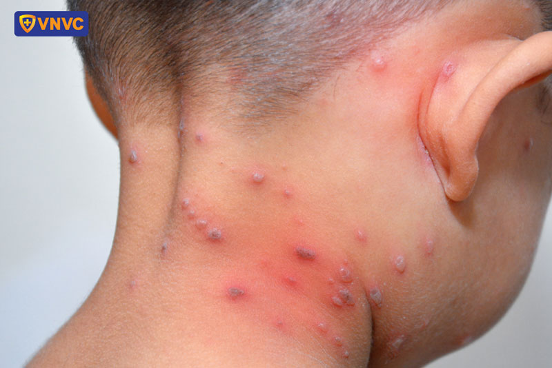 bị thuỷ đậu khi tắm tránh chà xát mạnh