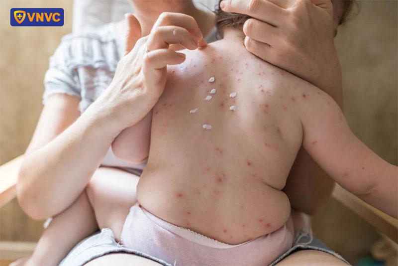 biến chứng của bệnh thuỷ đậu