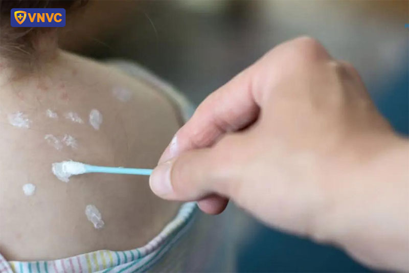 chăm sóc vùng da bằng cách bôi thuốc