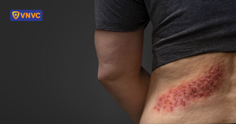 cơn đau zona thần kinh