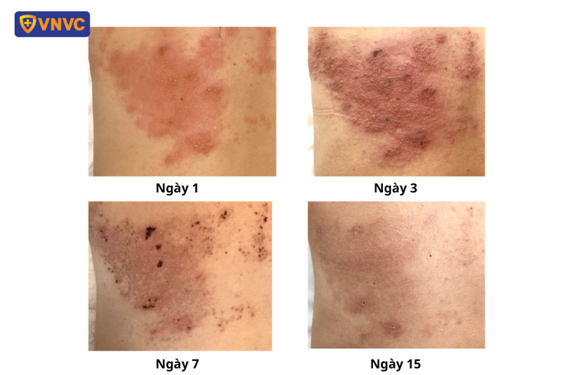 dấu hiệu nhiễm virus zona thần kinh