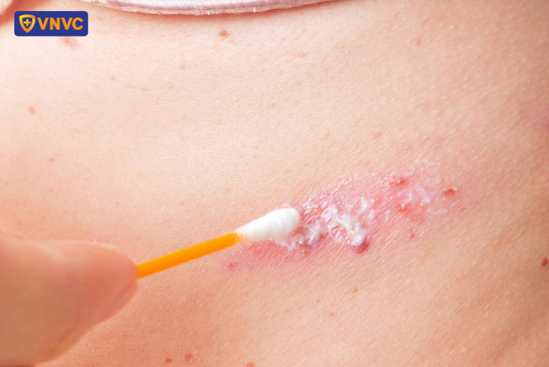 điều trị bênh zona thần kinh