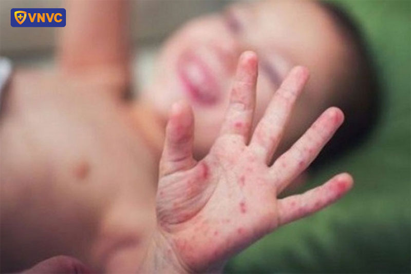 hình ảnh bệnh sởi ở trẻ sơ sinh