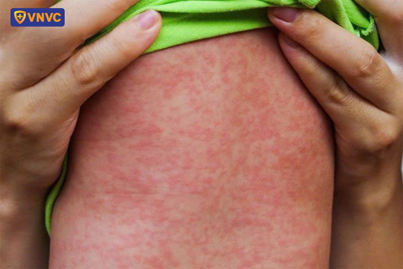 hình ảnh bệnh sởi ở trẻ sơ sinh