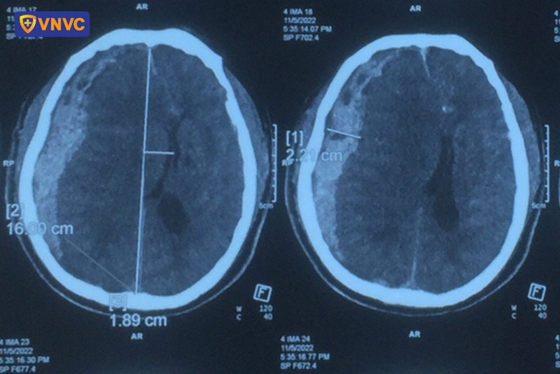 hình ảnh xuất huyết não khi bị sốt xuất huyết