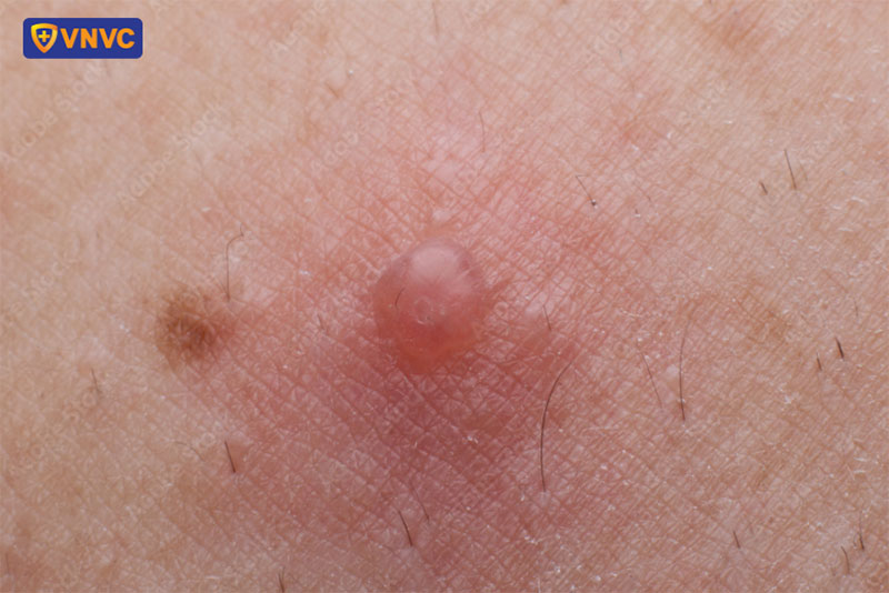 mụn nước do bệnh trái rạ